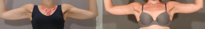 Arm Lift Case 1157 Before & After View #1 | Serving Rochester, Syracuse & Buffalo, NY | Quatela Center for Plastic Surgery