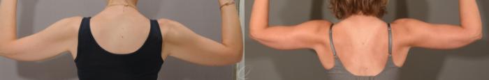Arm Lift Case 1157 Before & After View #2 | Serving Rochester, Syracuse & Buffalo, NY | Quatela Center for Plastic Surgery