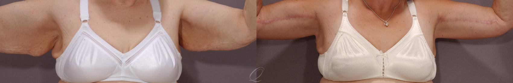 Arm Lift Case 135 Before & After View #1 | Serving Rochester, Syracuse & Buffalo, NY | Quatela Center for Plastic Surgery