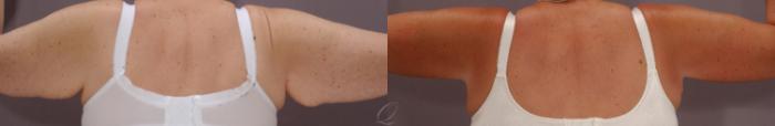 Arm Lift Case 135 Before & After View #2 | Serving Rochester, Syracuse & Buffalo, NY | Quatela Center for Plastic Surgery