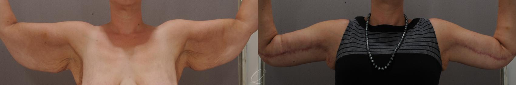 Arm Lift Case 136 Before & After View #1 | Serving Rochester, Syracuse & Buffalo, NY | Quatela Center for Plastic Surgery