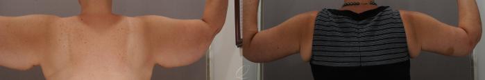 Arm Lift Case 136 Before & After View #2 | Serving Rochester, Syracuse & Buffalo, NY | Quatela Center for Plastic Surgery