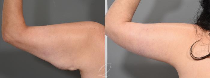 Arm Lift Case 1364 Before & After Left Side | Serving Rochester, Syracuse & Buffalo, NY | Quatela Center for Plastic Surgery