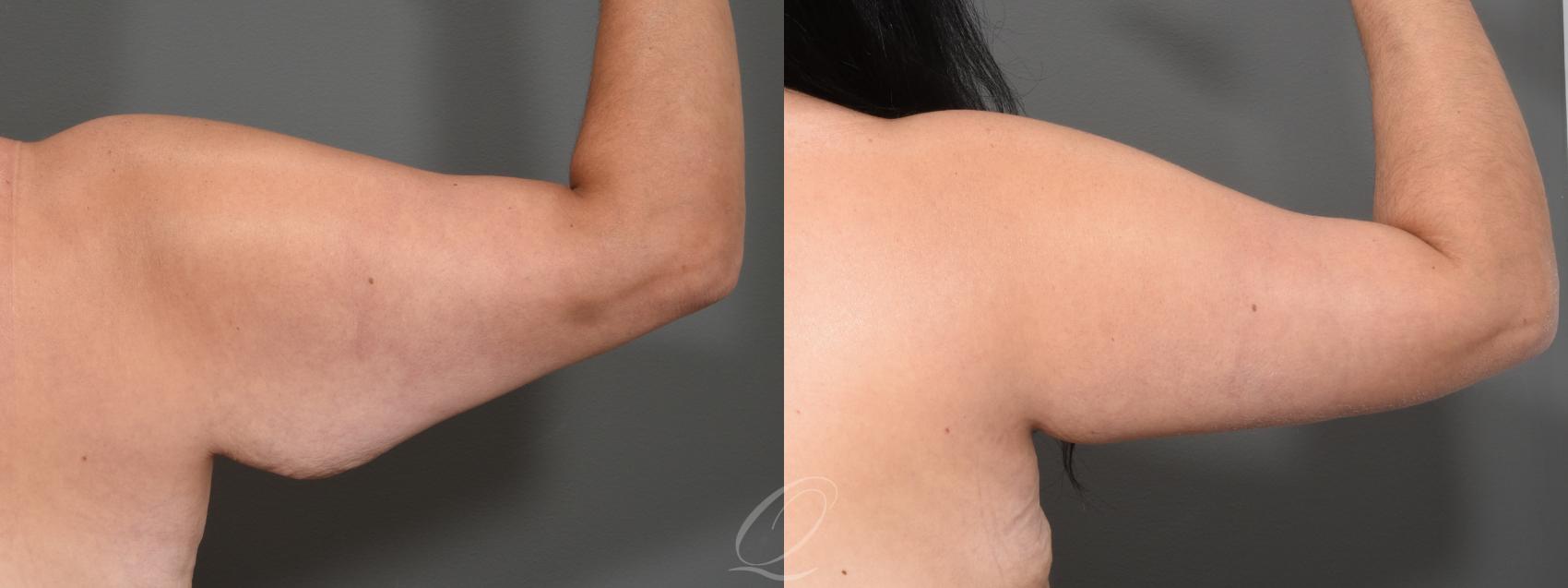 Arm Lift Case 1364 Before & After Right Side | Serving Rochester, Syracuse & Buffalo, NY | Quatela Center for Plastic Surgery