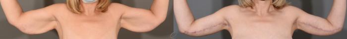 Arm Lift Case 1365 Before & After Front | Serving Rochester, Syracuse & Buffalo, NY | Quatela Center for Plastic Surgery