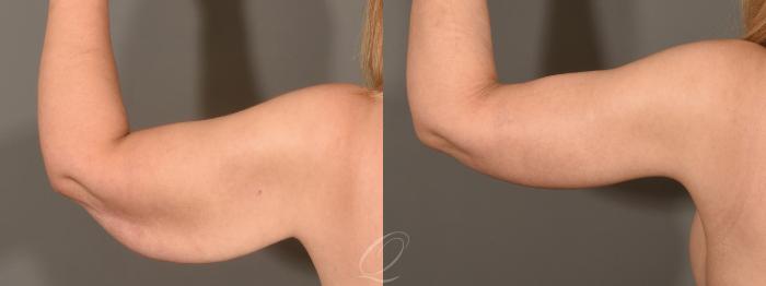 Arm Lift Case 1365 Before & After Left Side | Serving Rochester, Syracuse & Buffalo, NY | Quatela Center for Plastic Surgery