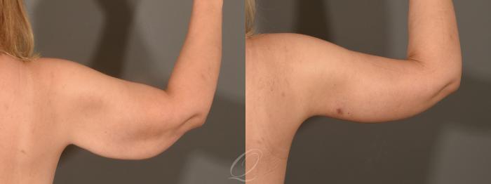 Arm Lift Case 1365 Before & After Right Side | Serving Rochester, Syracuse & Buffalo, NY | Quatela Center for Plastic Surgery