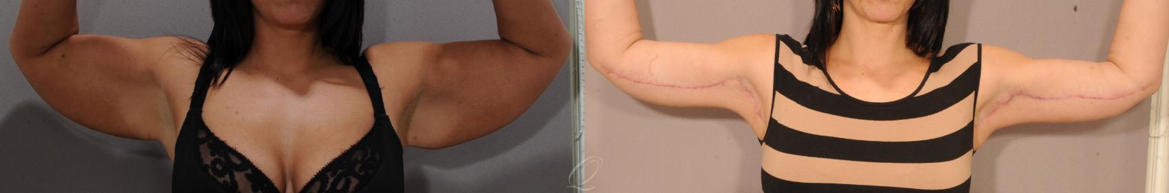 Arm Lift Case 137 Before & After View #1 | Serving Rochester, Syracuse & Buffalo, NY | Quatela Center for Plastic Surgery