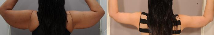 Arm Lift Case 137 Before & After View #2 | Serving Rochester, Syracuse & Buffalo, NY | Quatela Center for Plastic Surgery
