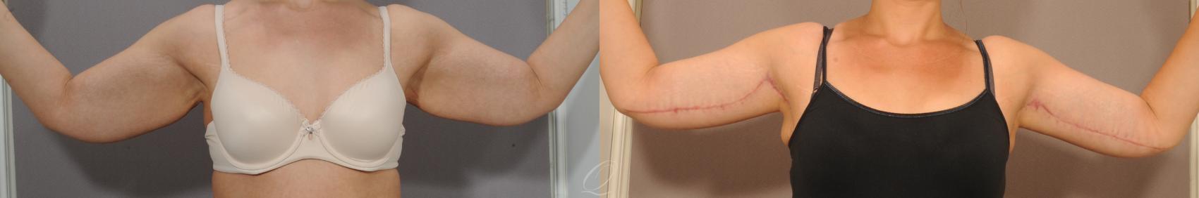 Arm Lift Case 138 Before & After View #1 | Serving Rochester, Syracuse & Buffalo, NY | Quatela Center for Plastic Surgery