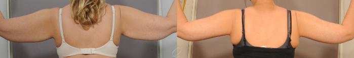 Arm Lift Case 138 Before & After View #2 | Serving Rochester, Syracuse & Buffalo, NY | Quatela Center for Plastic Surgery