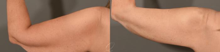 Arm Lift Case 390 Before & After Back Left Arm | Serving Rochester, Syracuse & Buffalo, NY | Quatela Center for Plastic Surgery