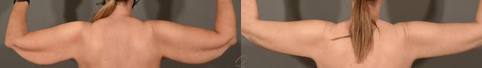 Arm Lift Case 390 Before & After Back | Serving Rochester, Syracuse & Buffalo, NY | Quatela Center for Plastic Surgery