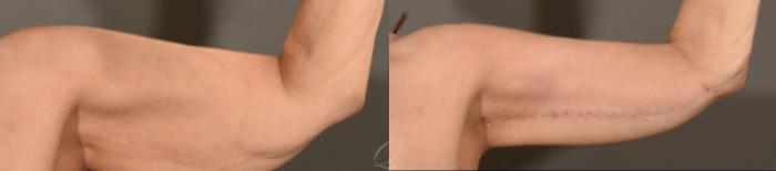Arm Lift Case 390 Before & After Front Left Arm | Serving Rochester, Syracuse & Buffalo, NY | Quatela Center for Plastic Surgery