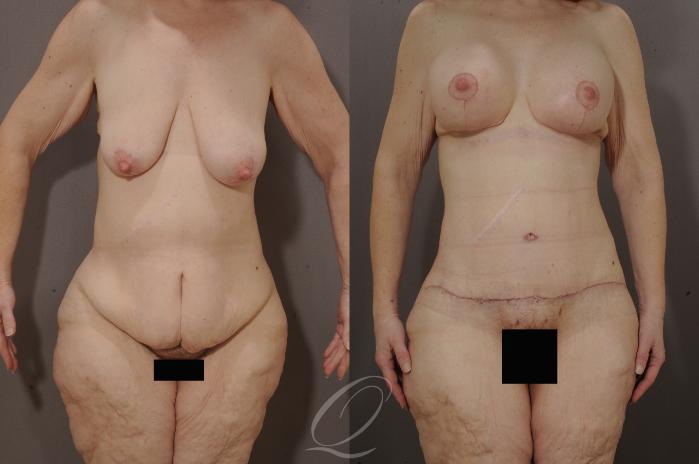 Body Contouring after Weight Loss Case 200 Before & After View #1 | Serving Rochester, Syracuse & Buffalo, NY | Quatela Center for Plastic Surgery