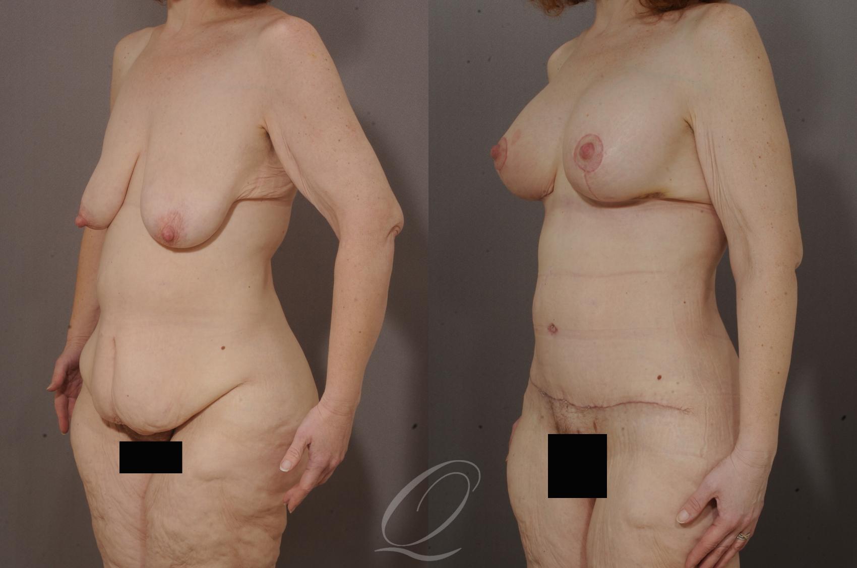 Body Contouring after Weight Loss Case 200 Before & After View #2 | Serving Rochester, Syracuse & Buffalo, NY | Quatela Center for Plastic Surgery
