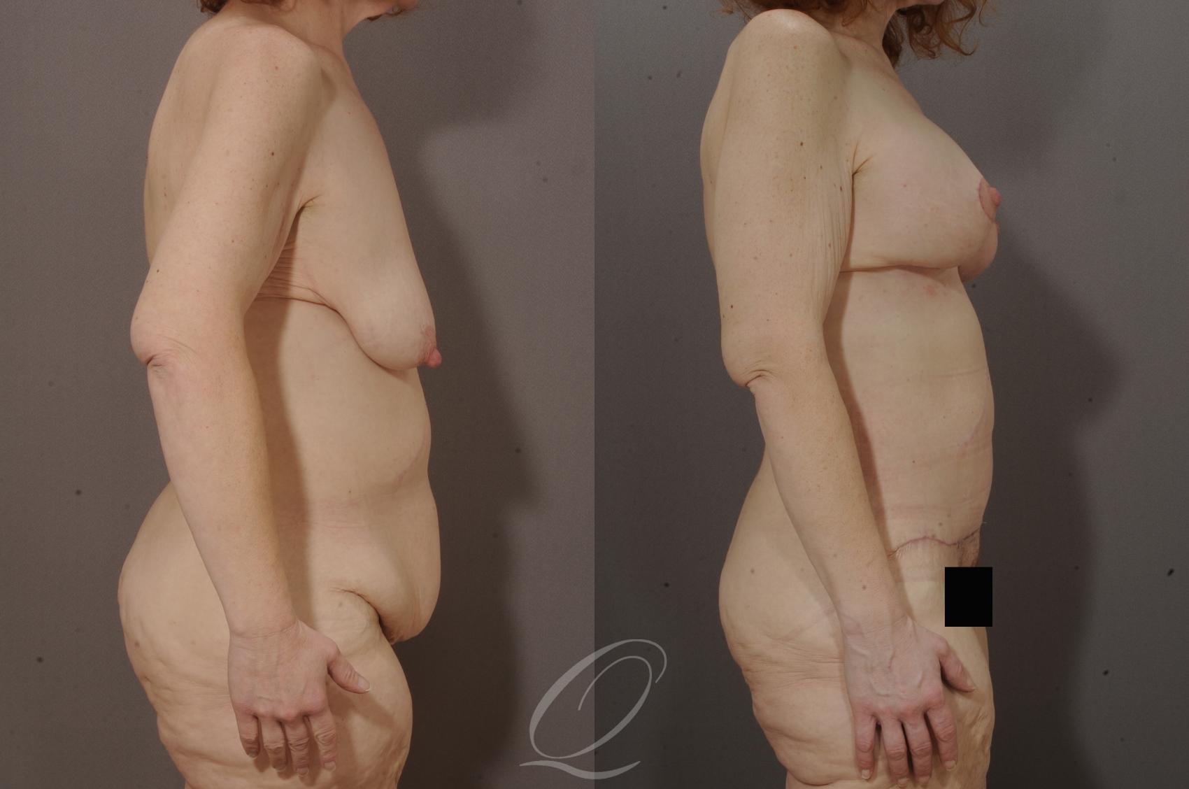 Body Contouring after Weight Loss Case 200 Before & After View #3 | Serving Rochester, Syracuse & Buffalo, NY | Quatela Center for Plastic Surgery