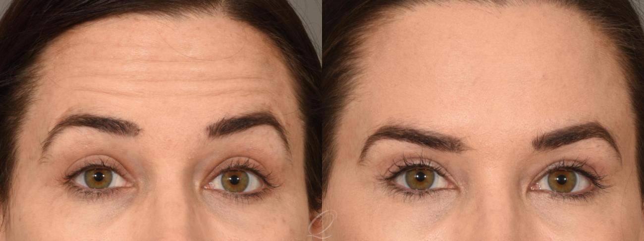 BOTOX® Case 1001296 Before & After View #1 | Serving Rochester, Syracuse & Buffalo, NY | Quatela Center for Plastic Surgery