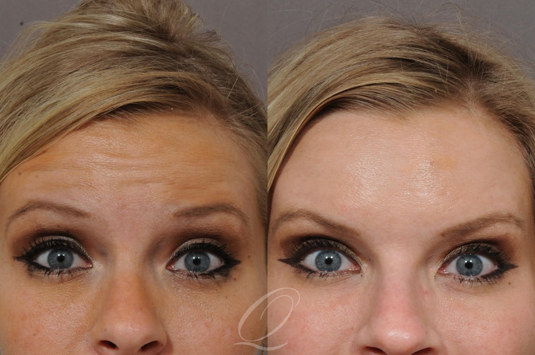 BOTOX® Case 218 Before & After View #1 | Serving Rochester, Syracuse & Buffalo, NY | Quatela Center for Plastic Surgery