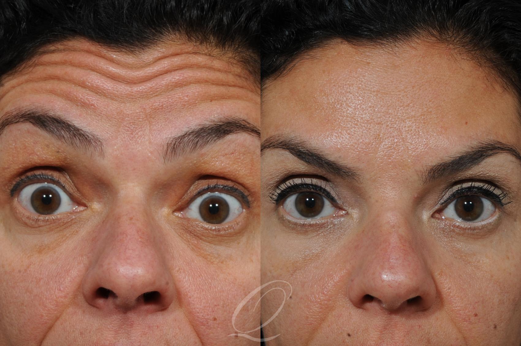 BOTOX® Case 229 Before & After View #1 | Serving Rochester, Syracuse & Buffalo, NY | Quatela Center for Plastic Surgery
