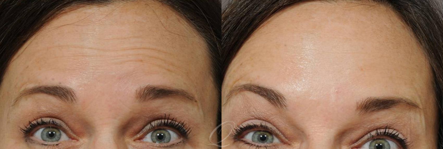 BOTOX® Case 231 Before & After View #1 | Serving Rochester, Syracuse & Buffalo, NY | Quatela Center for Plastic Surgery