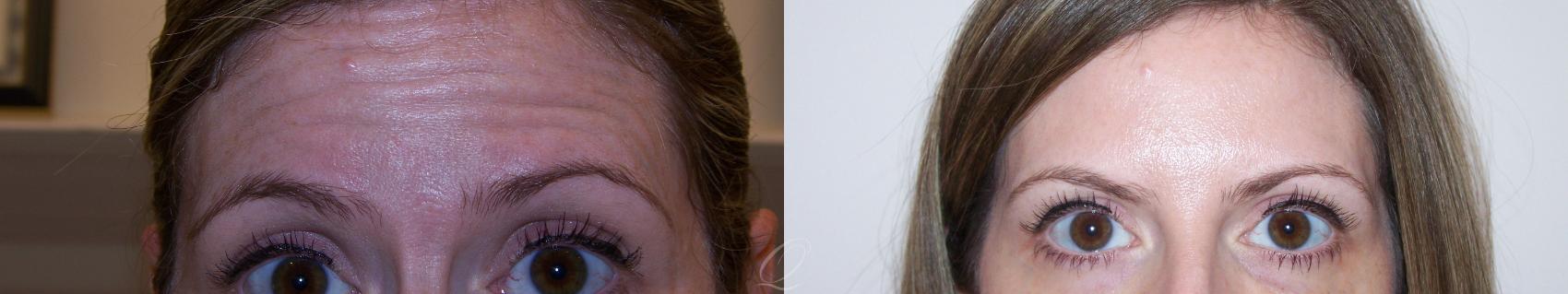 BOTOX® Case 234 Before & After View #1 | Serving Rochester, Syracuse & Buffalo, NY | Quatela Center for Plastic Surgery