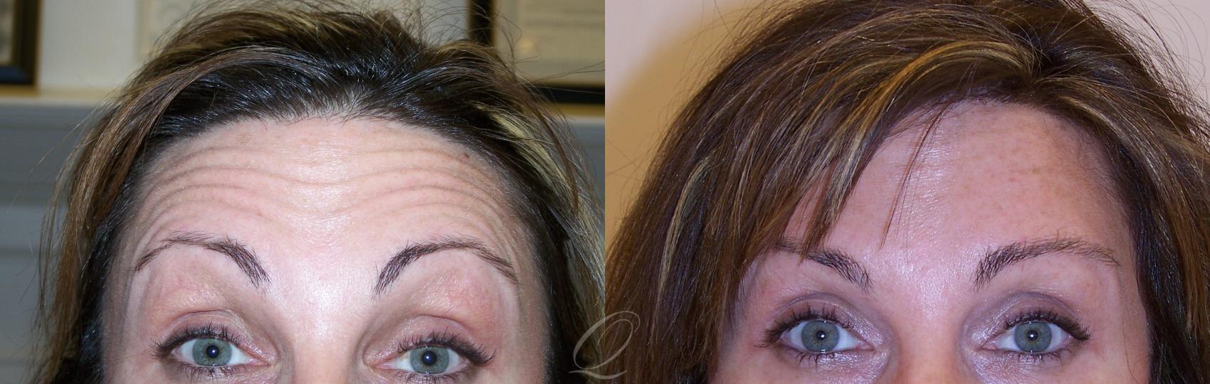 BOTOX® Case 235 Before & After View #1 | Serving Rochester, Syracuse & Buffalo, NY | Quatela Center for Plastic Surgery