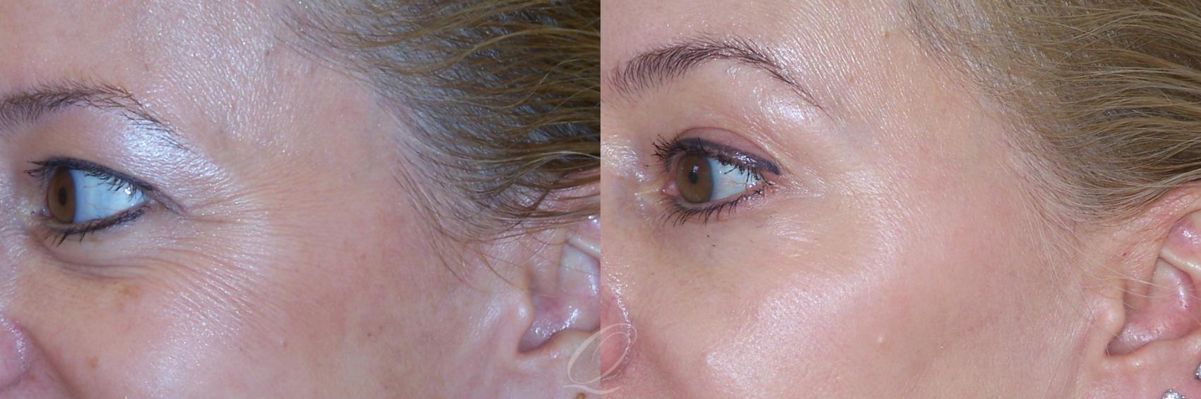 BOTOX® Case 236 Before & After View #1 | Serving Rochester, Syracuse & Buffalo, NY | Quatela Center for Plastic Surgery