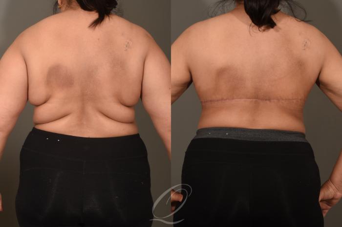 Bra Line Back Lift Case 1001679 Before & After Back 2 | Serving Rochester, Syracuse & Buffalo, NY | Quatela Center for Plastic Surgery