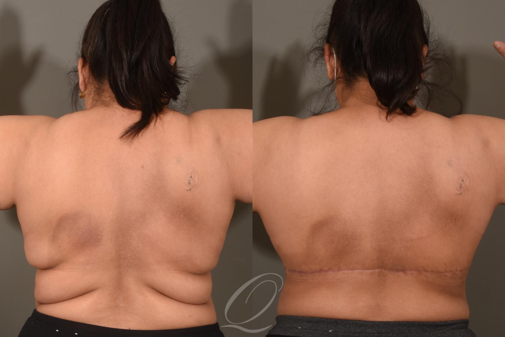 Bra Line Back Lift Case 1001679 Before & After Back | Serving Rochester, Syracuse & Buffalo, NY | Quatela Center for Plastic Surgery