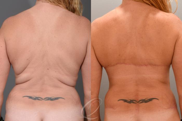 Bra Line Back Lift Case 1001680 Before & After Back | Serving Rochester, Syracuse & Buffalo, NY | Quatela Center for Plastic Surgery