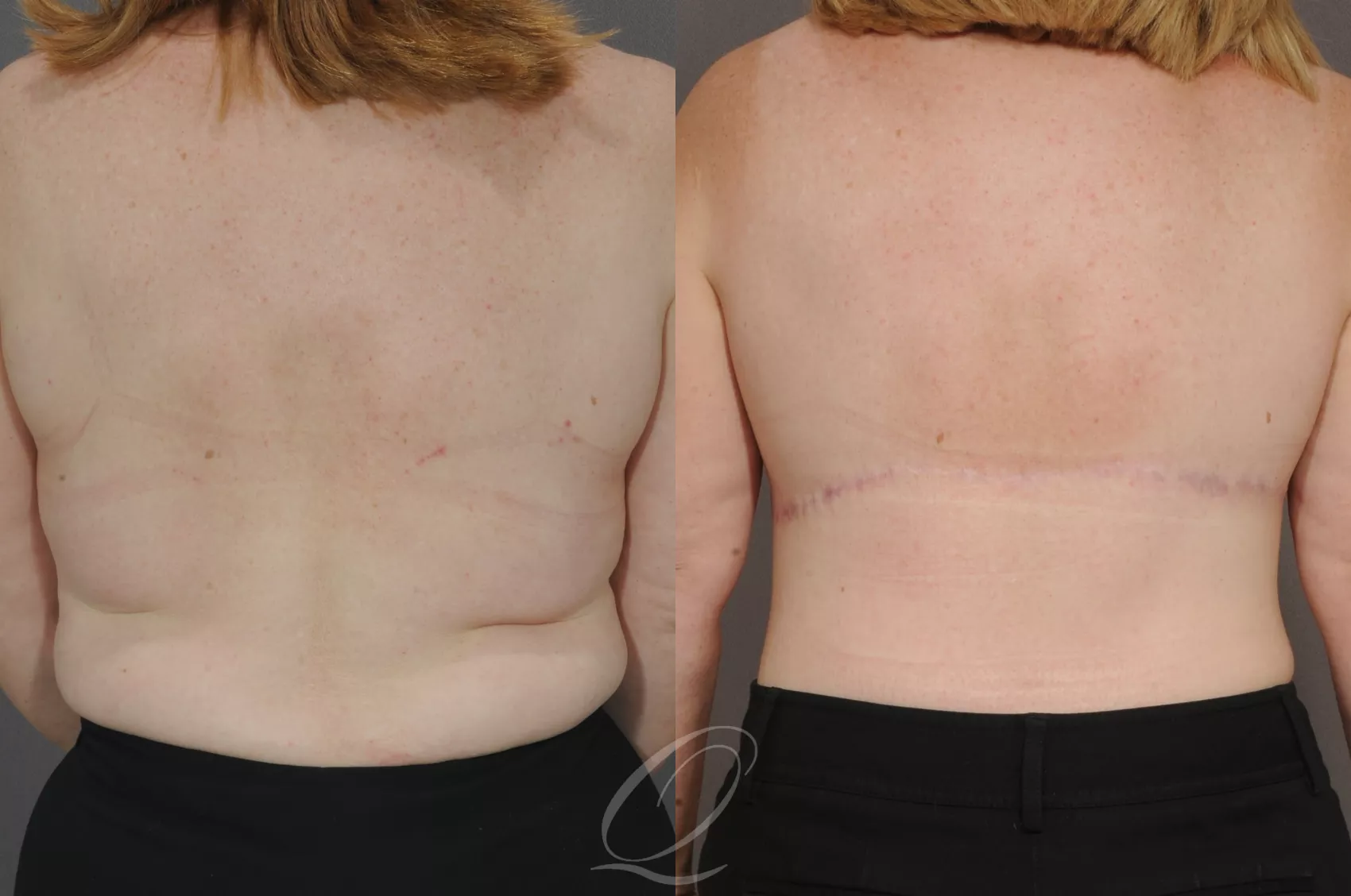 Bra Line Back Lift Before and After Pictures Case 1314, Paramus, NJ