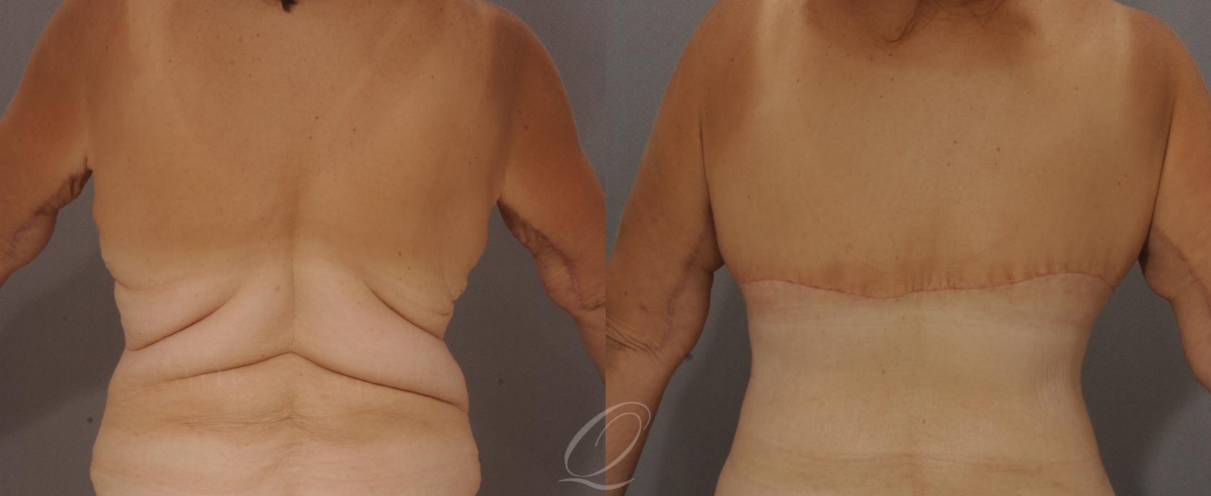 Bra Line Back Lift Case 113 Before & After View #1 | Serving Rochester, Syracuse & Buffalo, NY | Quatela Center for Plastic Surgery
