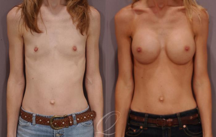 Breast Augmentation Case 100 Before & After View #1 | Serving Rochester, Syracuse & Buffalo, NY | Quatela Center for Plastic Surgery