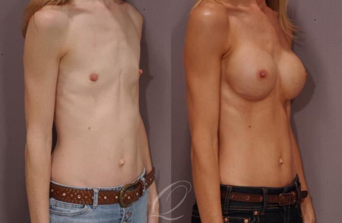 Breast Augmentation Case 100 Before & After View #2 | Serving Rochester, Syracuse & Buffalo, NY | Quatela Center for Plastic Surgery