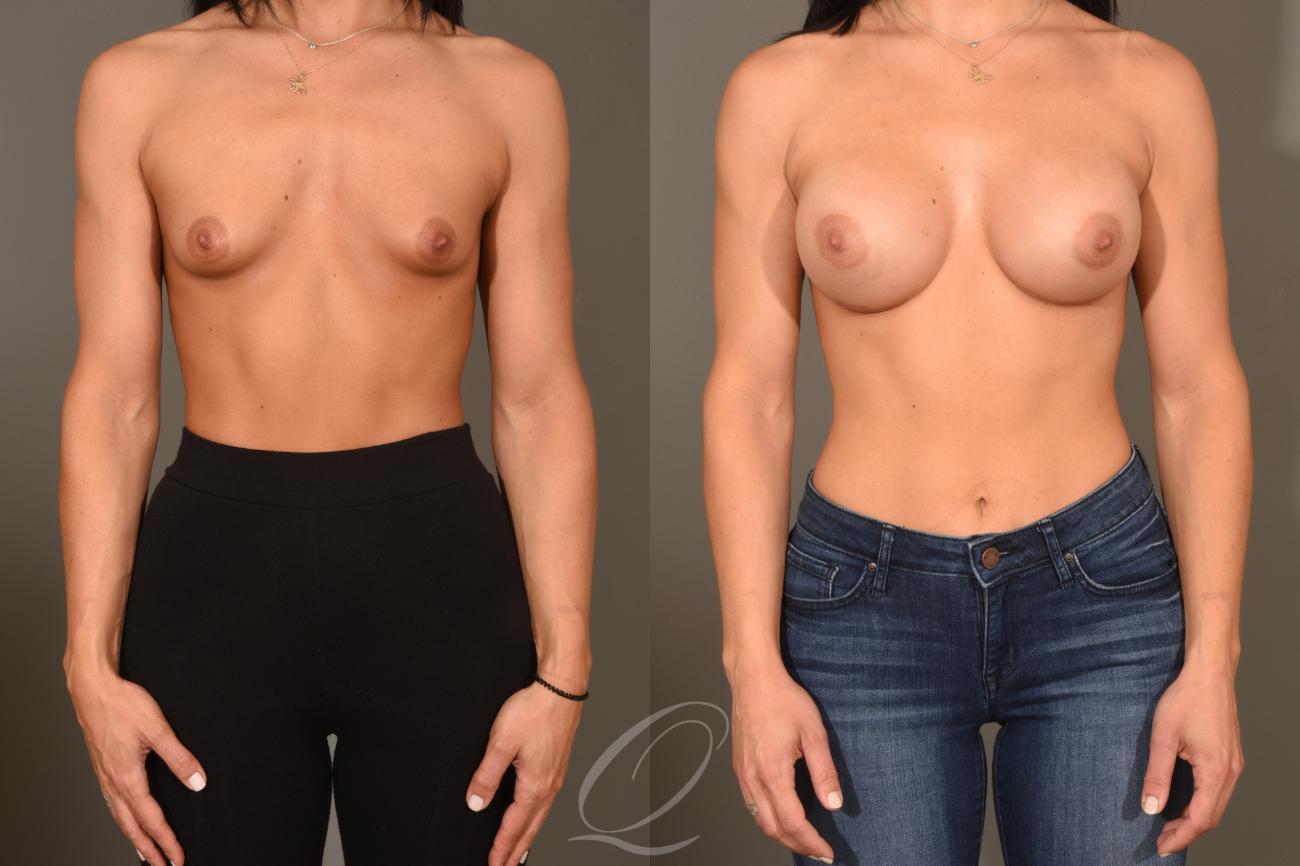Breast Augmentation Case 401 Before & After Front | Serving Rochester, Syracuse & Buffalo, NY | Quatela Center for Plastic Surgery
