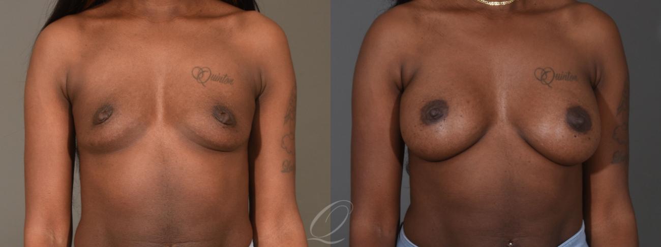 Breast Augmentation Case 1451 Before & After Front | Serving Rochester, Syracuse & Buffalo, NY | Quatela Center for Plastic Surgery