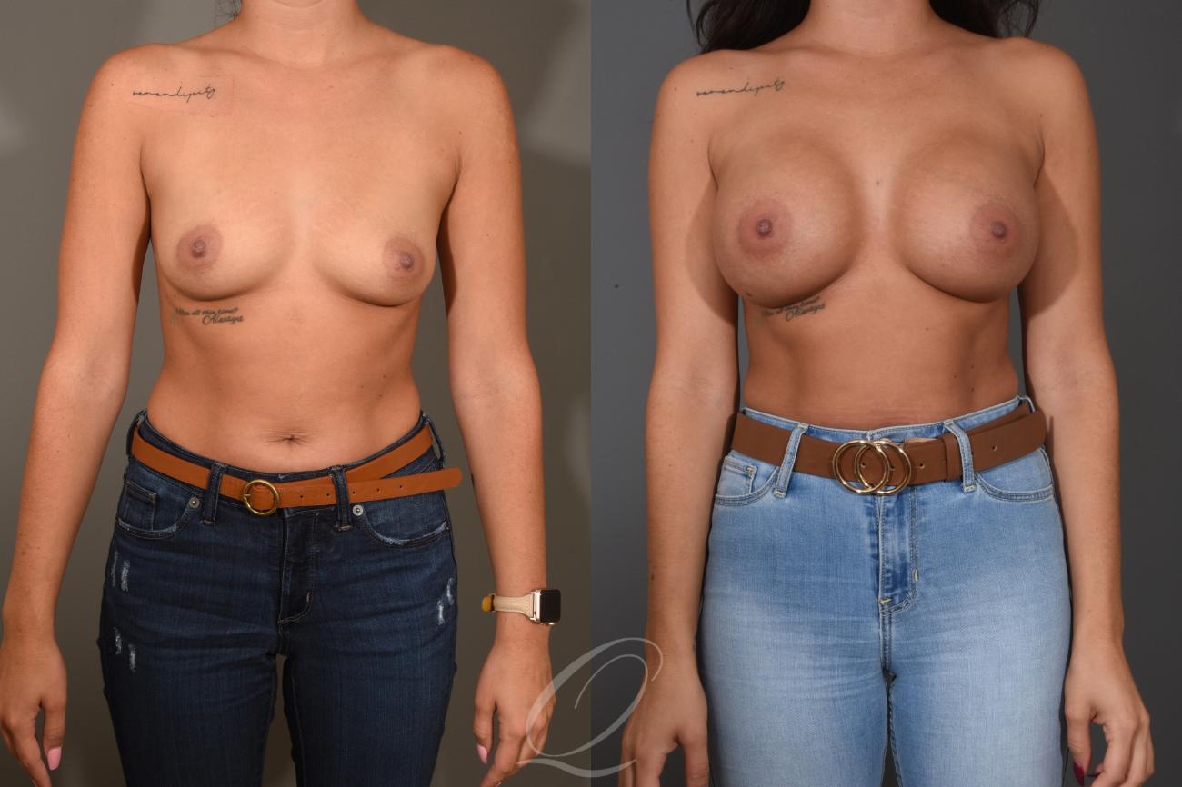 Breast Augmentation Case 1481 Before & After Front | Serving Rochester, Syracuse & Buffalo, NY | Quatela Center for Plastic Surgery