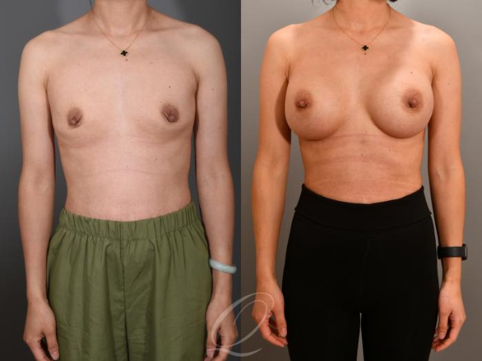Breast Augmentation Case 1001556 Before & After Front | Serving Rochester, Syracuse & Buffalo, NY | Quatela Center for Plastic Surgery