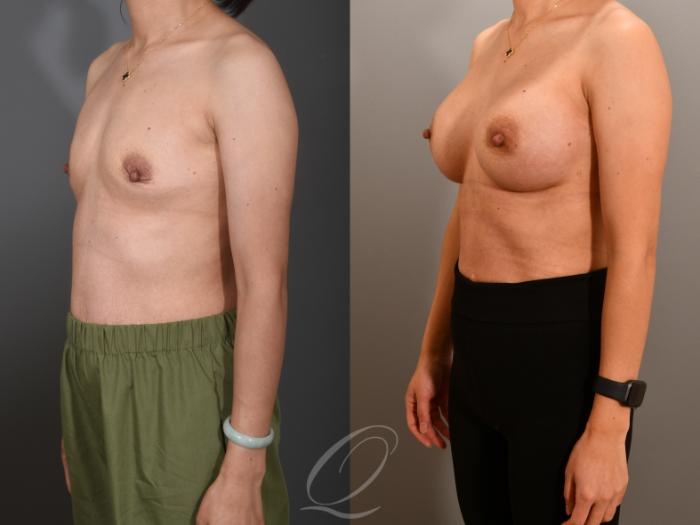 Breast Augmentation Case 1001556 Before & After Left Oblique | Serving Rochester, Syracuse & Buffalo, NY | Quatela Center for Plastic Surgery