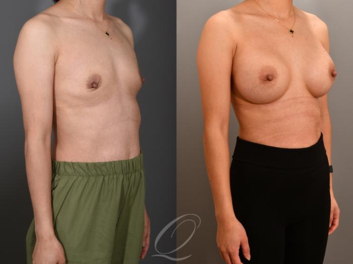 Breast Augmentation Case 1001556 Before & After Right Oblique | Serving Rochester, Syracuse & Buffalo, NY | Quatela Center for Plastic Surgery