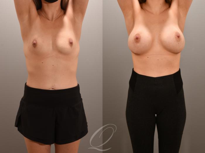 Breast Augmentation Case 1001559 Before & After Arms Up | Serving Rochester, Syracuse & Buffalo, NY | Quatela Center for Plastic Surgery
