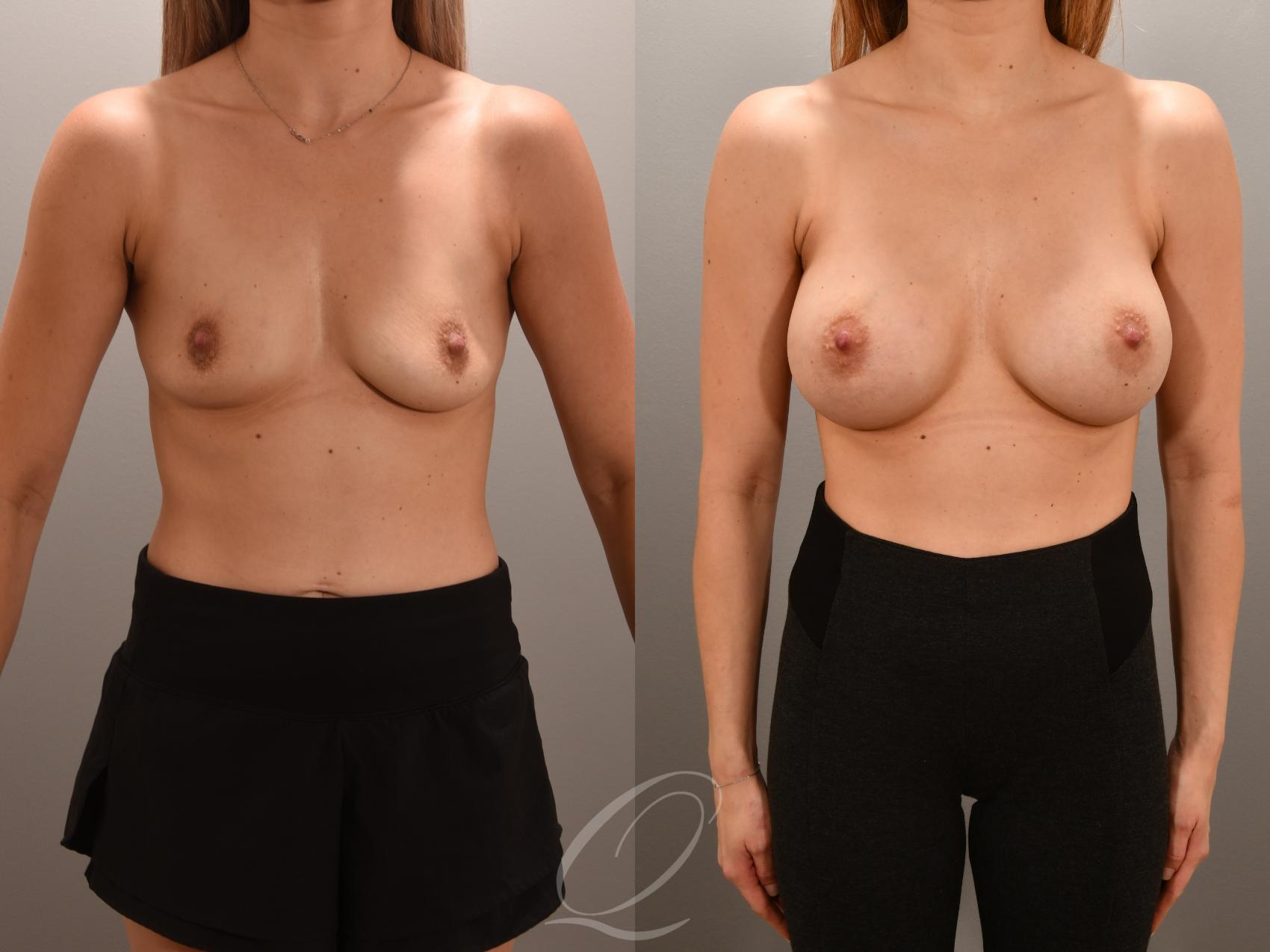 Breast Augmentation Case 1001559 Before & After Front | Serving Rochester, Syracuse & Buffalo, NY | Quatela Center for Plastic Surgery