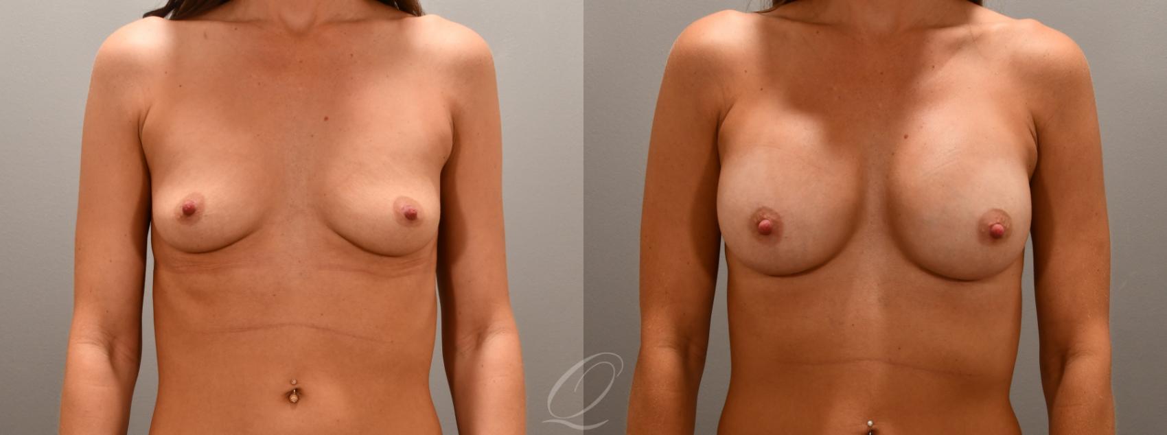 Breast Augmentation Case 1001592 Before & After Front | Serving Rochester, Syracuse & Buffalo, NY | Quatela Center for Plastic Surgery