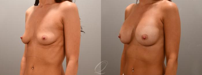 Breast Augmentation Case 1001592 Before & After Left Oblique | Serving Rochester, Syracuse & Buffalo, NY | Quatela Center for Plastic Surgery