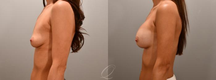 Breast Augmentation Case 1001592 Before & After Left Side | Serving Rochester, Syracuse & Buffalo, NY | Quatela Center for Plastic Surgery