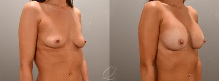 Breast Augmentation Case 1001592 Before & After Right Oblique | Serving Rochester, Syracuse & Buffalo, NY | Quatela Center for Plastic Surgery