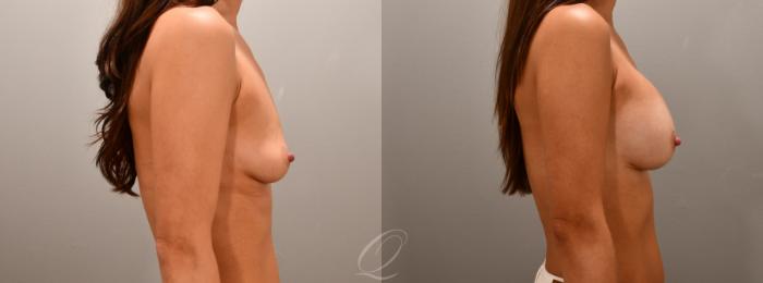 Breast Augmentation Case 1001592 Before & After Right Side | Serving Rochester, Syracuse & Buffalo, NY | Quatela Center for Plastic Surgery