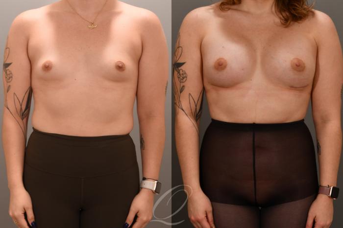 Breast Augmentation Case 1001655 Before & After Front | Serving Rochester, Syracuse & Buffalo, NY | Quatela Center for Plastic Surgery