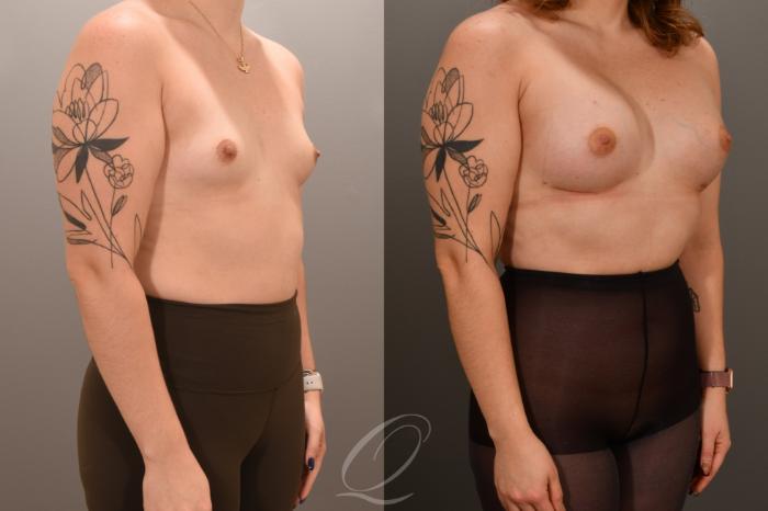 Breast Augmentation Case 1001655 Before & After Right Oblique | Serving Rochester, Syracuse & Buffalo, NY | Quatela Center for Plastic Surgery